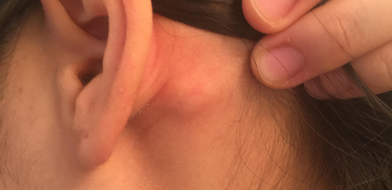 Got a lump on your neck, back or behind your ear? This is what you need to know