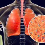 How-to-remove-Mucus-from-the-Lungs